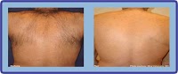 Laser Hair Removal Group 378544 Image 3